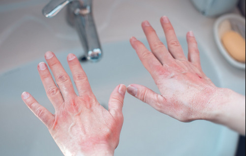 atopic dermatitis hand
